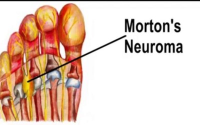 Neuroma de Morton